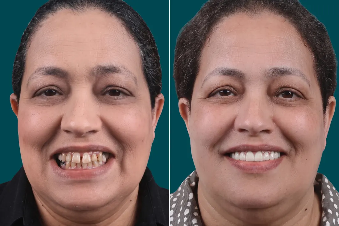 Hollywood smile, before and after