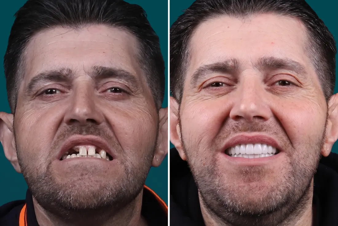 Dental implants, before and after
