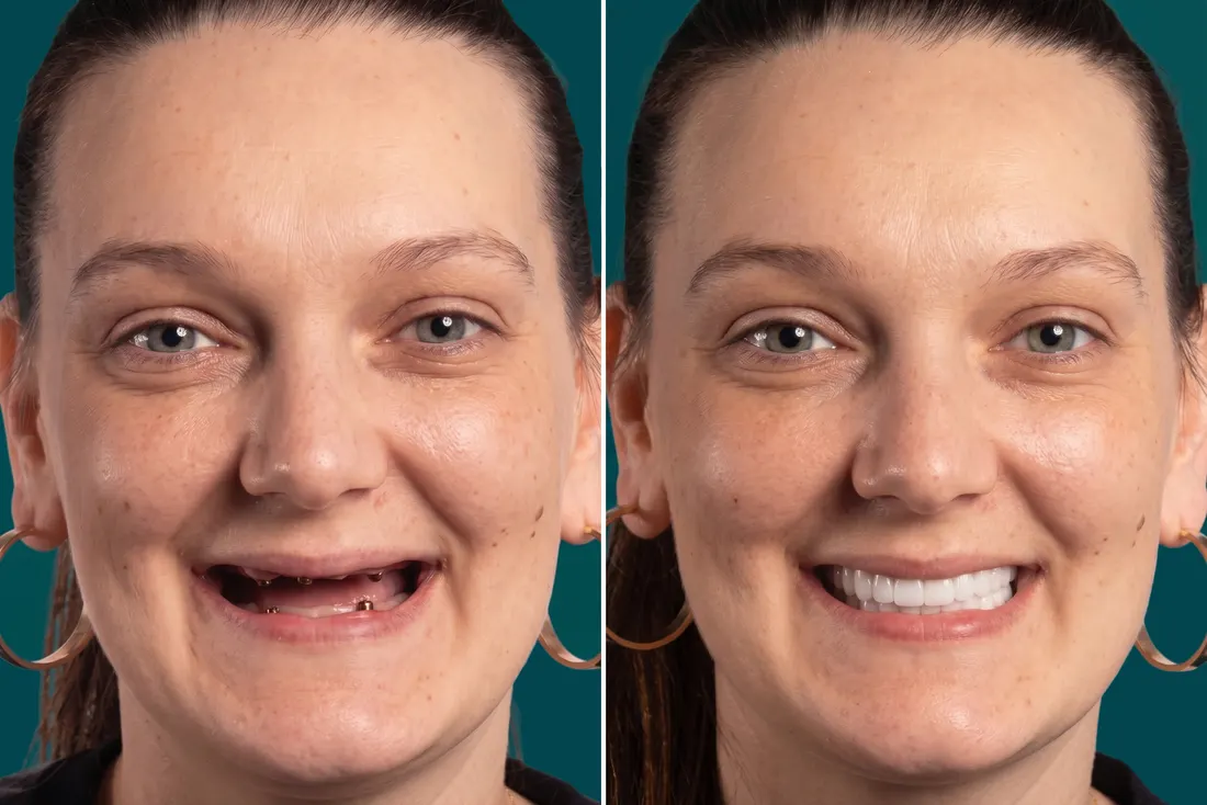 All-on-4 implants, before and after