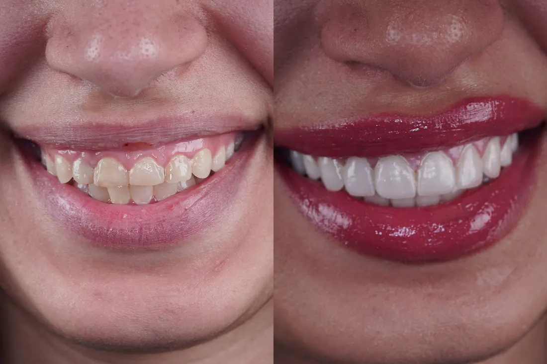Smile makeover, before and after