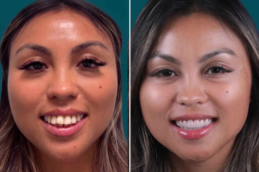 Dental crowns, before and after