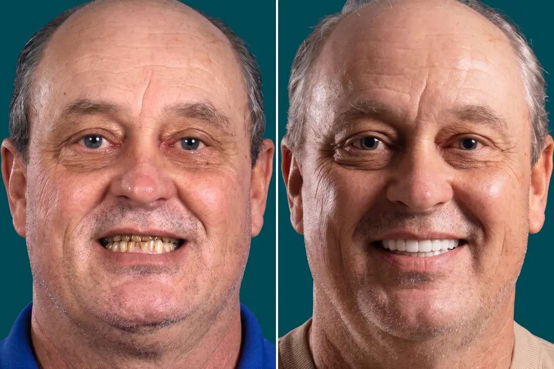 Porcelain veneers, before and after