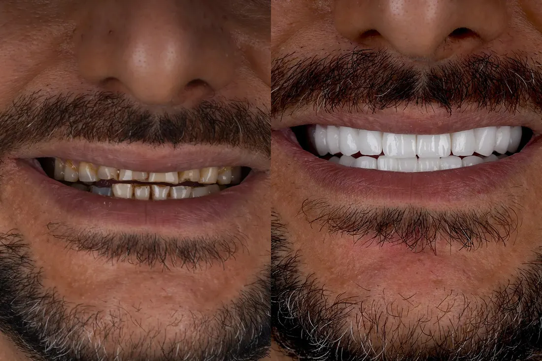 Smile makeover, before and after
