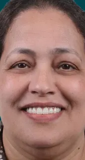 Hollywood smile result at a partner clinic