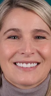 Veneers result at a partner clinic