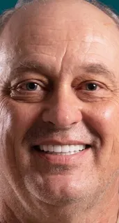 Veneers result at a partner clinic